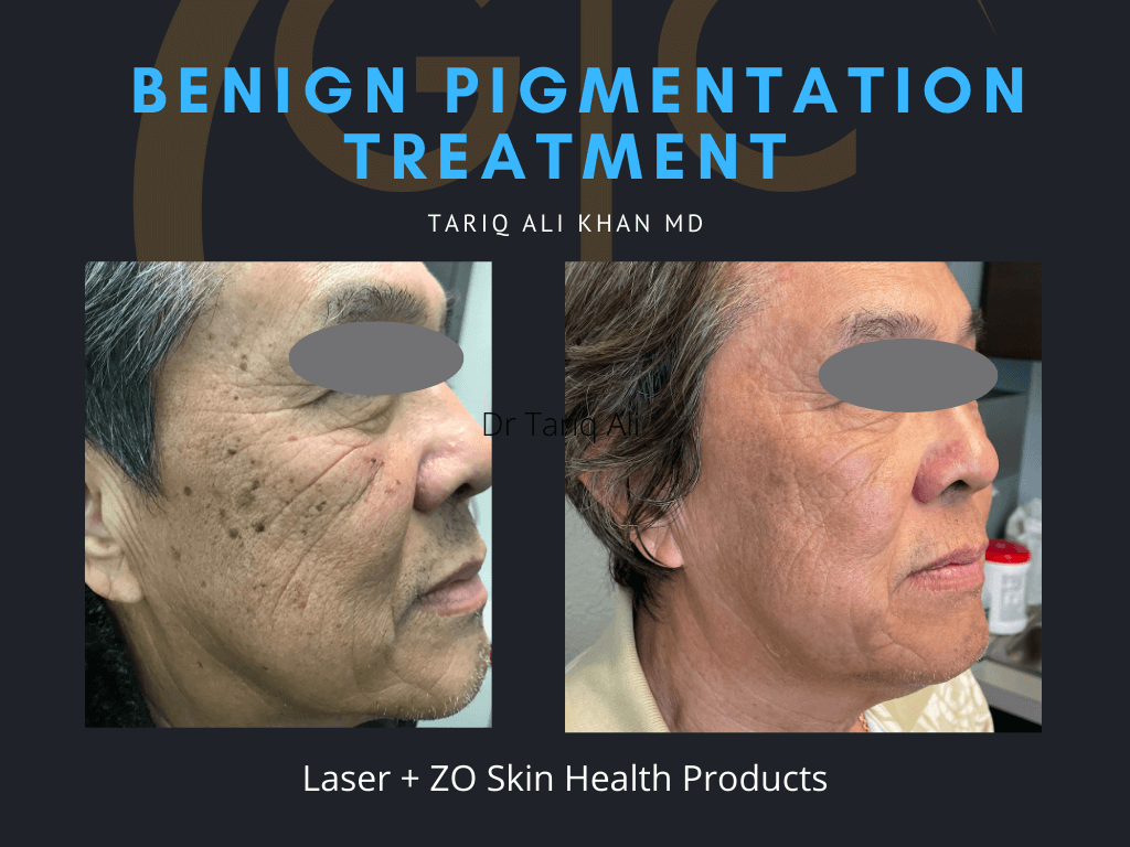 Gentle Care Laser Tustin Before and After picture - Mole Removal